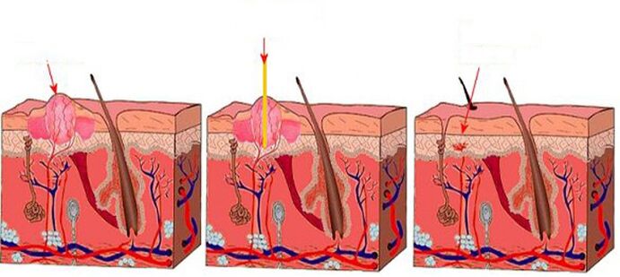 How laser works on papillomas