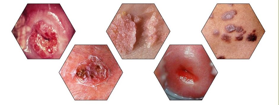 dangerous types of papillomas