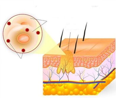 how a wart grows