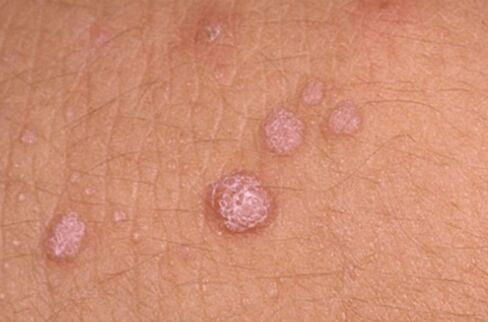 Symptoms of human papillomavirus