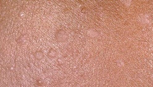 flat warts on human skin