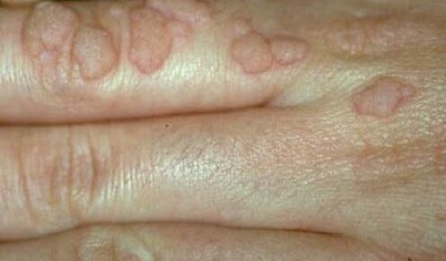 human papillomavirus on hands