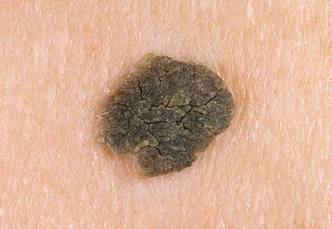 black wart on the skin
