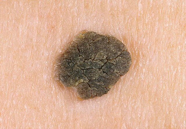 wart on the skin