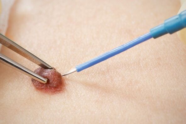 Electrocoagulation of the papilloma