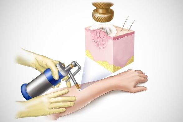 Papilloma cryosurgery
