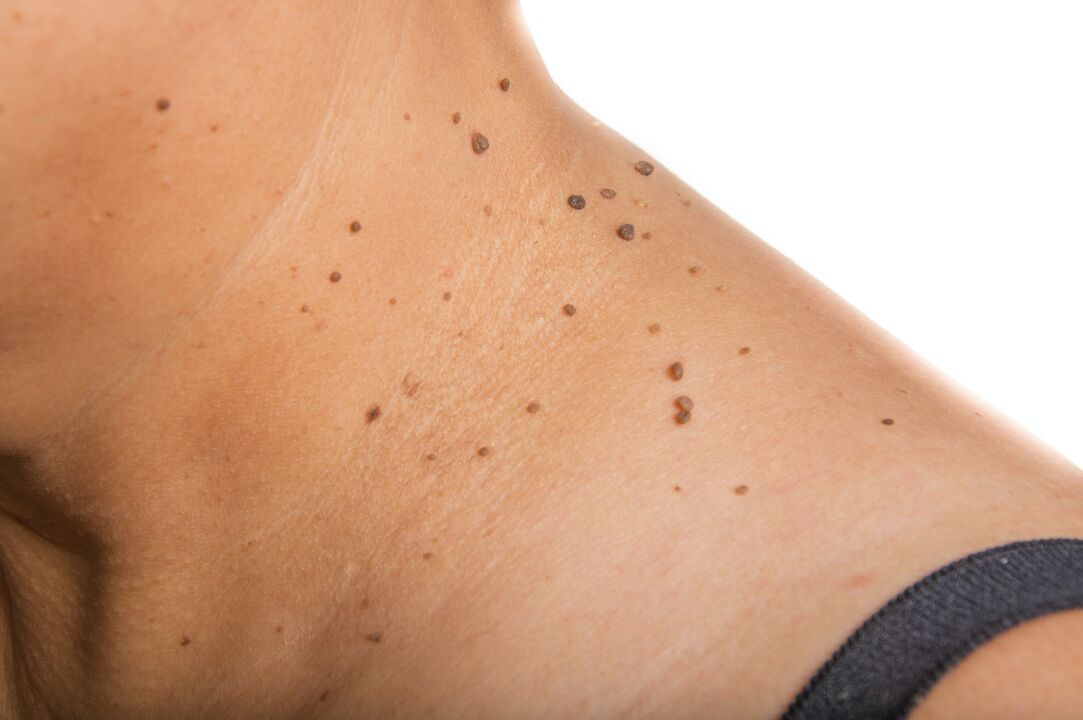 a handful of papillomas on the neck