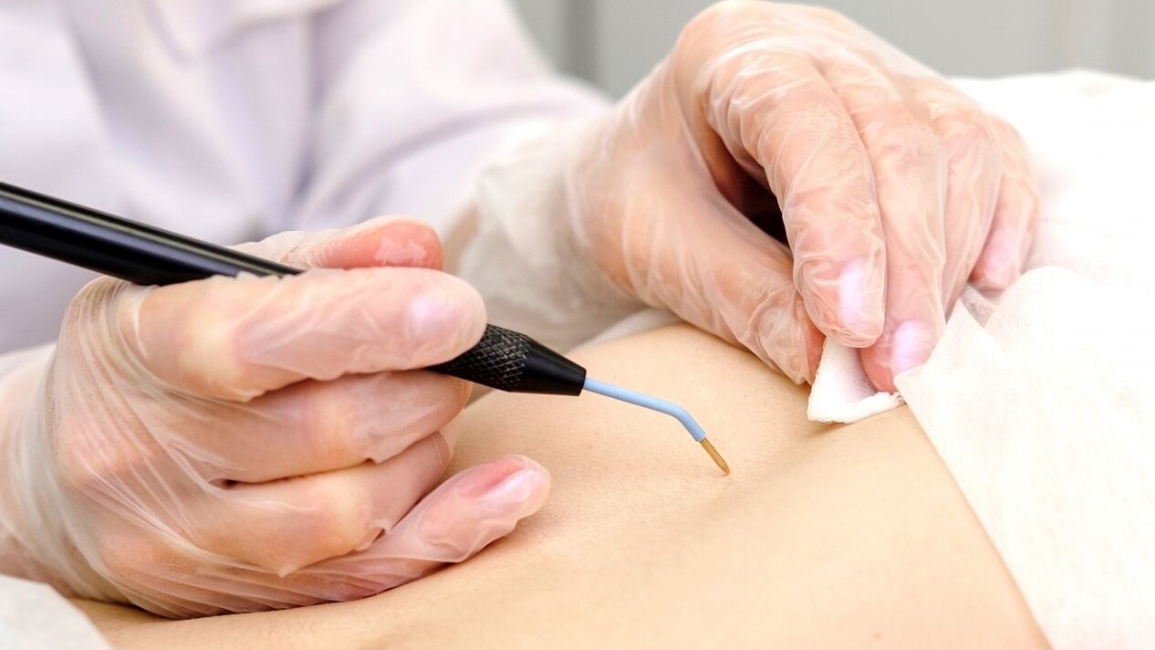 ways to remove papillomas